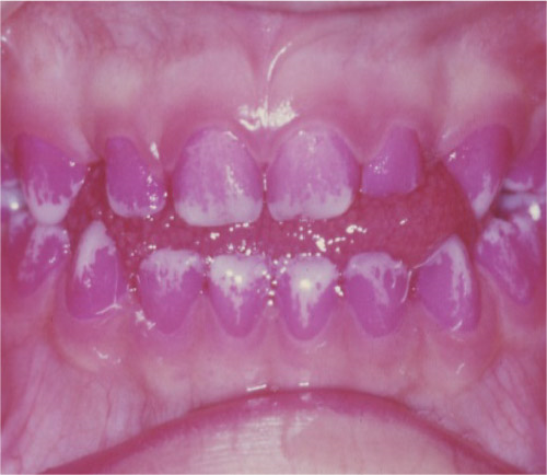 歯の汚れの染め出し