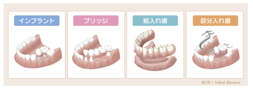 欠損補綴治療においても患者様のニーズに応じた対応を行っています