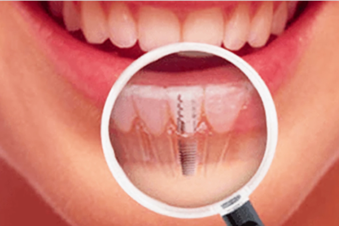 安全なインプラント治療を提供