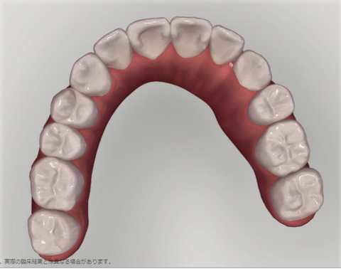クリンチェックというシュミレーターシステムを活用し矯正を行います