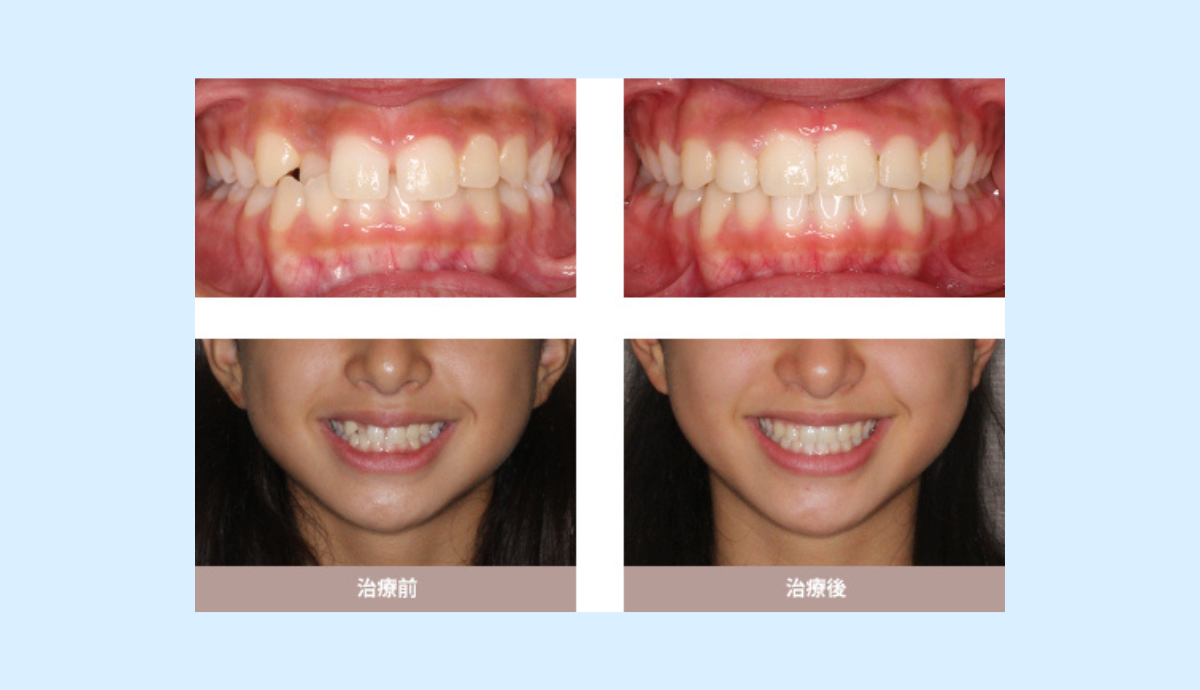 虫歯・歯周病治療の融合プラン