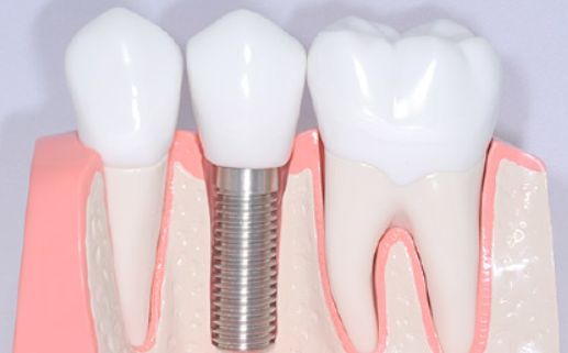 機能性と美しさを兼ね備えたインプラント