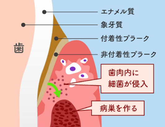 歯周病の発生要因