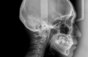 しっかり噛める喜びを、インプラントで取り戻す