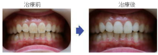 ホワイトニングの治療例