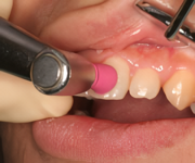 丁寧で精度の高い基本診療で歯を守ります：かえで歯科医院の一般歯科