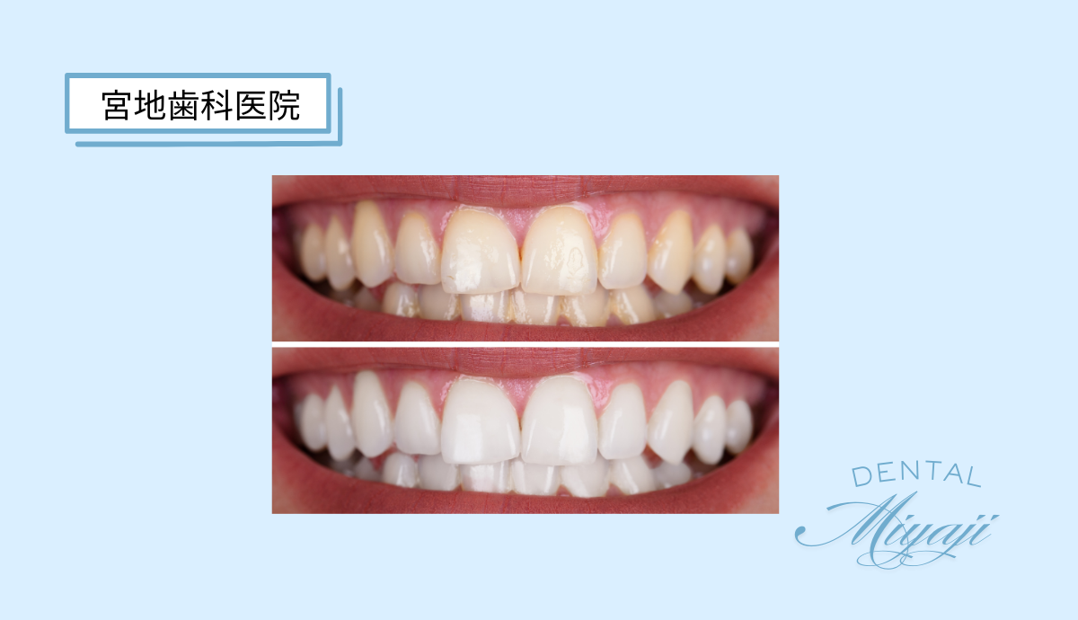 【目立ちにくい入れ歯】ノンクラスプナチュラルデンチャー
