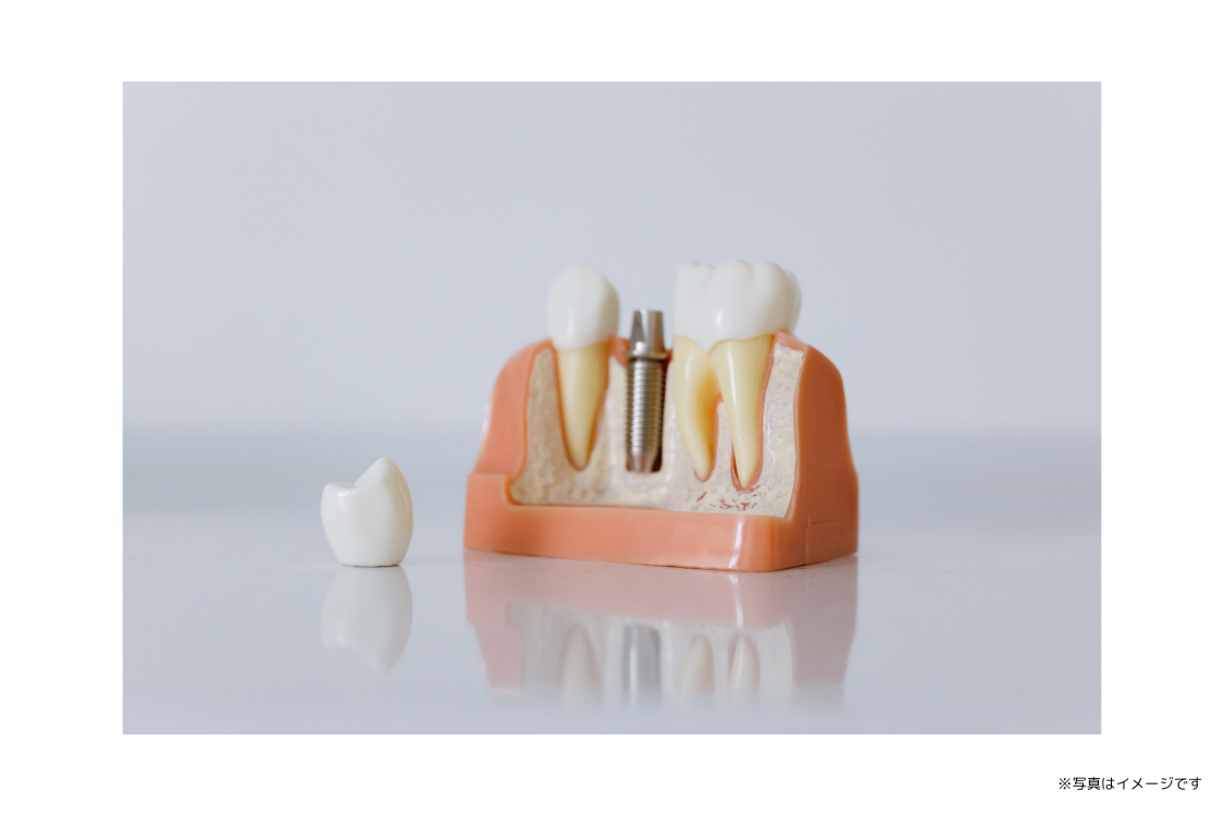 歯を失った箇所に人工歯根を埋め込み、機能と見た目の回復を図るインプラント治療が行われています