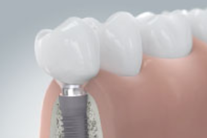 インプラントはお任せください