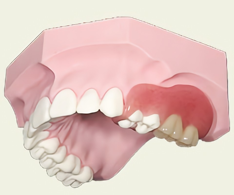 ノンクラスプデンチャー