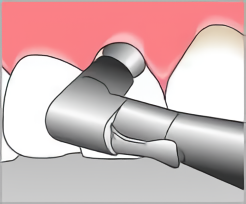PMTCのイメージ図