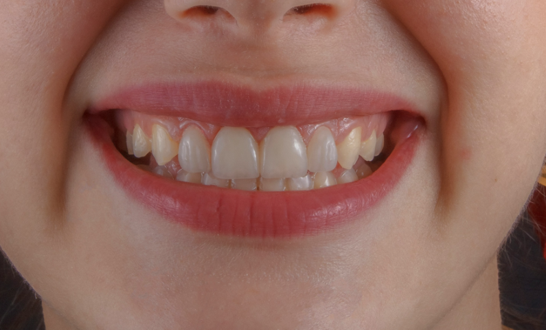 笑顔を引き立てる、自然な口元づくり