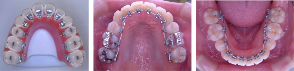 舌側矯正装置（金属製）