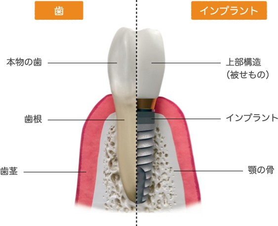 歯周病のリスクを抑えるインプラント治療を提供しています