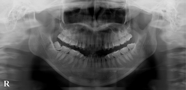 デジタルパノラマ・デンタルにより被曝X線量が軽減されています