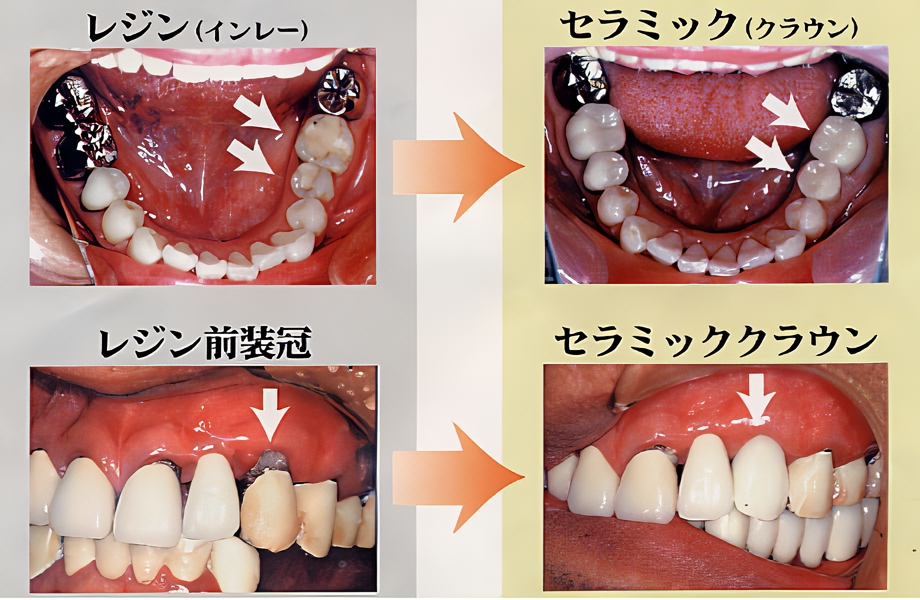 ご希望に応じた補綴をいたします