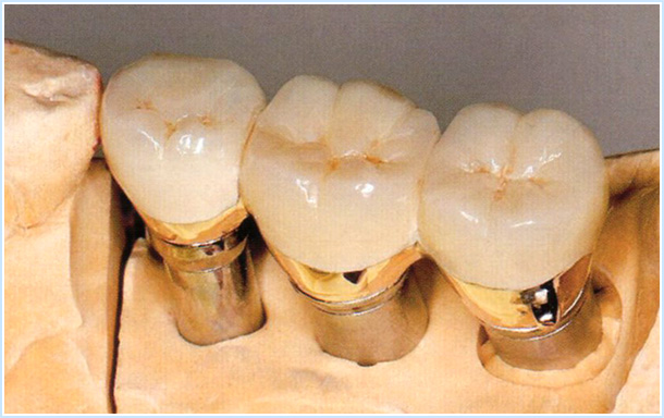 自分の歯と同じ感覚で噛める、高品質インプラント治療