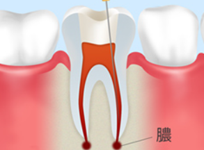 根管治療のイメージ