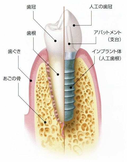 インプラント治療の図解