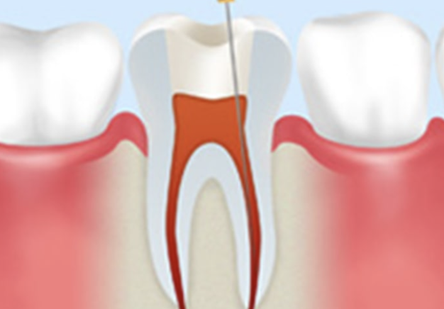 お口全体を守る根管治療を提供します
