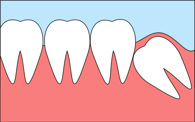 親知らずについてもご相談ください