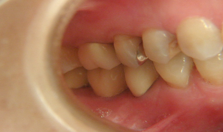 雑司が谷デンタルクリニックでインプラント治療を行い23年経過した症例。