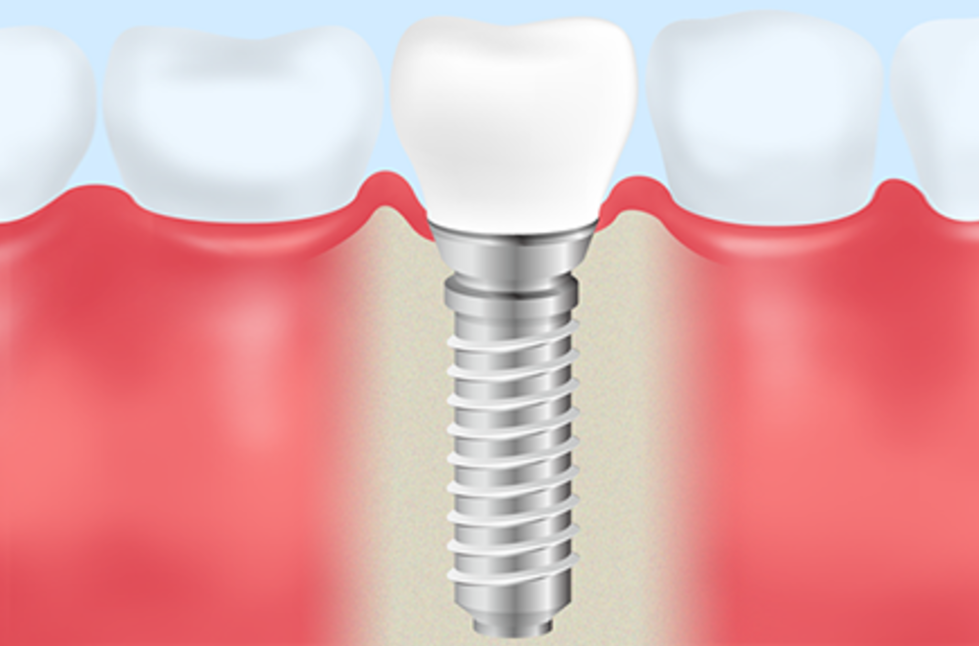 精密な診断と高度な技術で、安全で長持ちするインプラントを提供