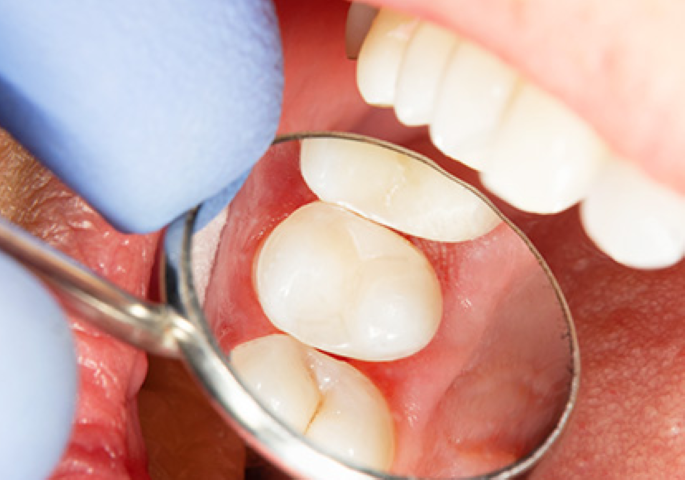 痛みに配慮し、患者様に寄り添う虫歯治療