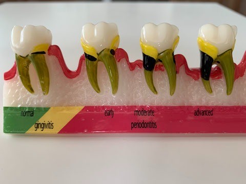 歯の状態や希望に合わせて素材を提案し、自然で違和感の少ない仕上がりにつなげています。