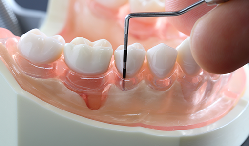 歯周病は早期発見・早期治療が重要です