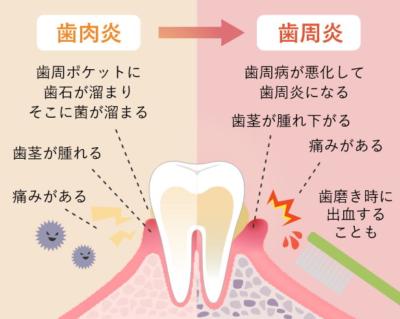 進行度に応じた適切なアプローチで歯の土台を守っています