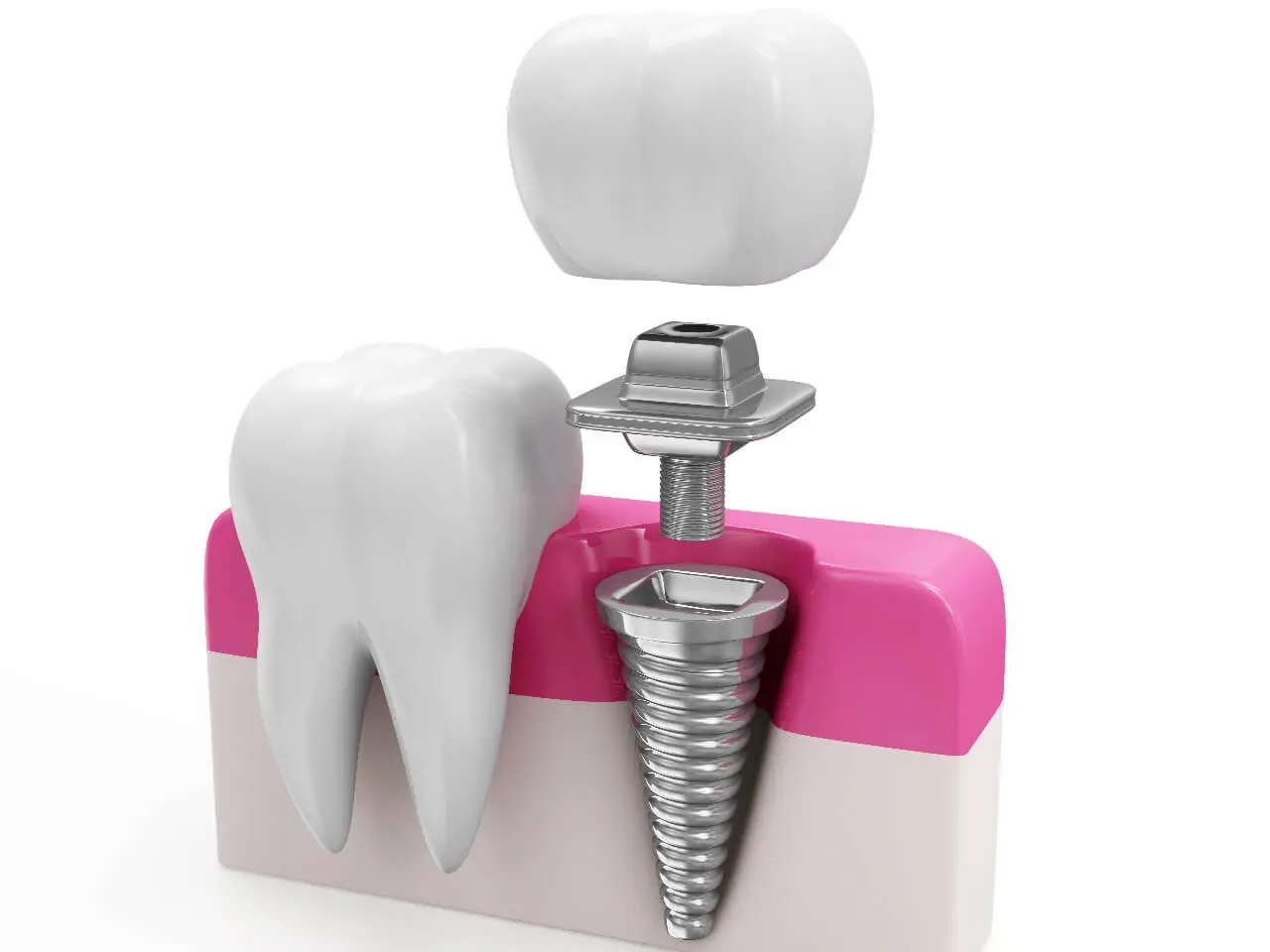 歯を失った部分に人工の歯根を埋め込むインプラント治療を提供しています