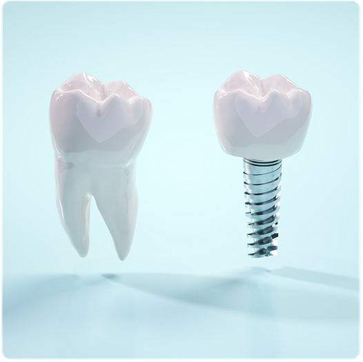自分の歯のようにしっかり噛めるインプラント