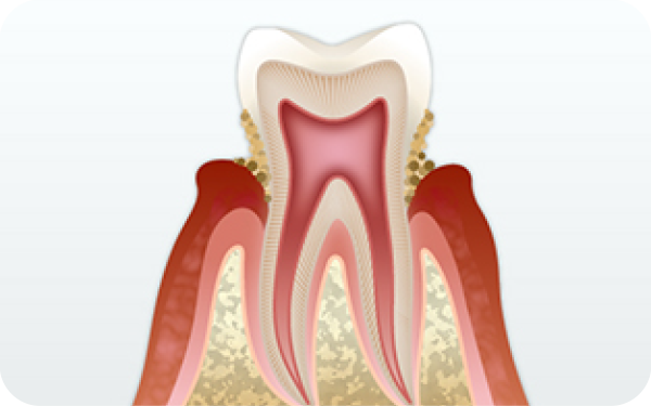 歯周病のイメージです。