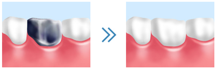 歯を白くして美しい口元に