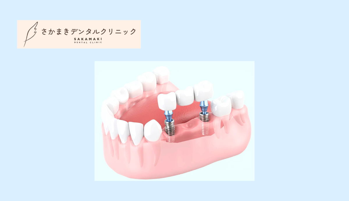 インプラントで第二の永久歯」で快適な毎日へ