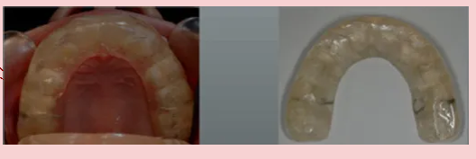 矯正治療前のスプリント療法の写真