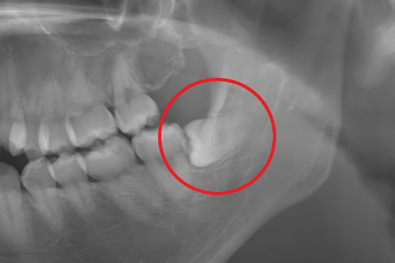 横に傾いた親知らずでも抜歯可能です