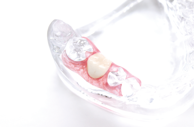 歯を失ってしまってお悩みの方は、一度ご相談ください