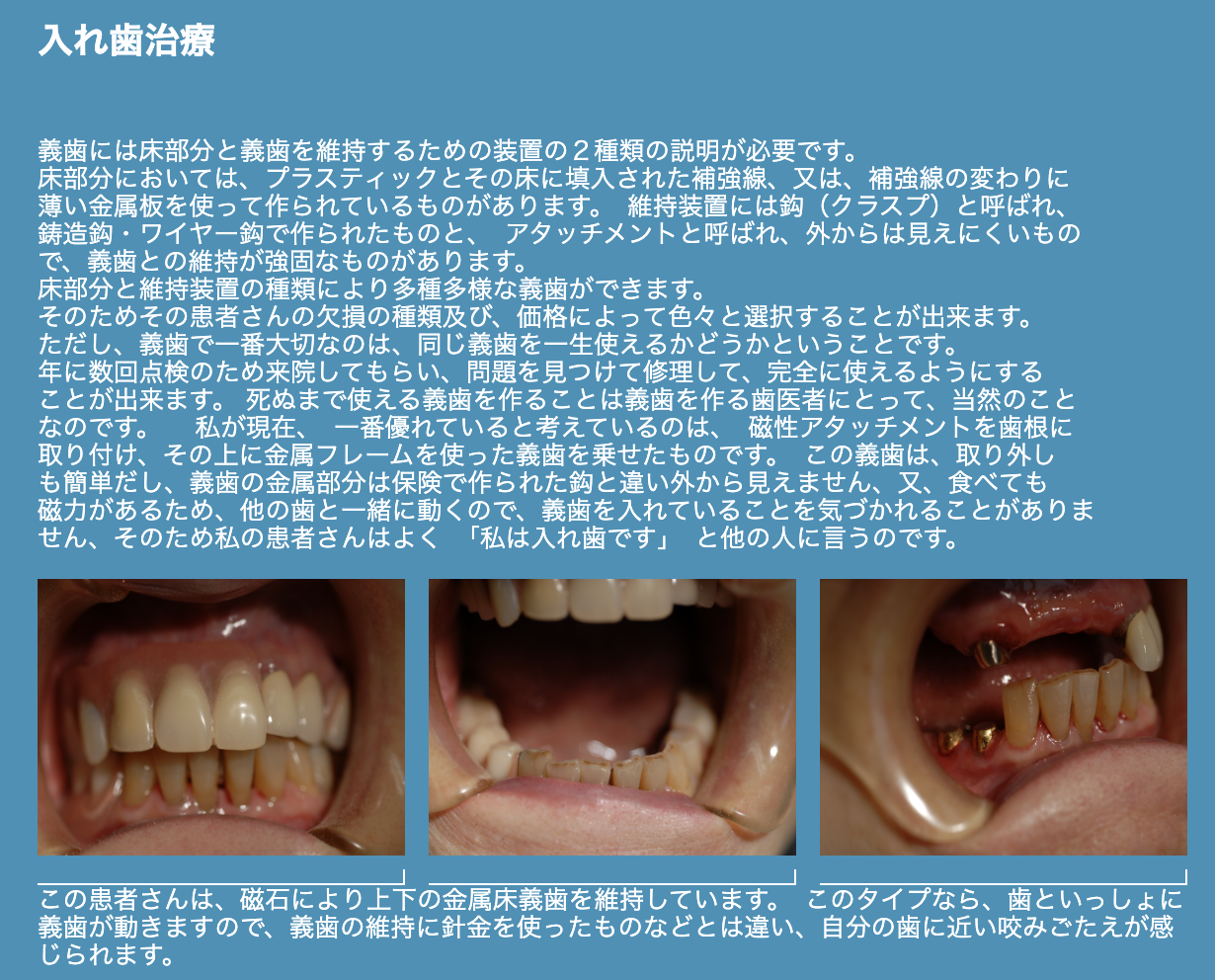 義歯の種類や構造に関する丁寧な説明を行い、患者様に適した選択ができるようにサポートしています