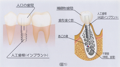 事前の診査をもとに治療計画を立て、抜歯程度の小さな手術で顎の骨に人工歯根を埋入します