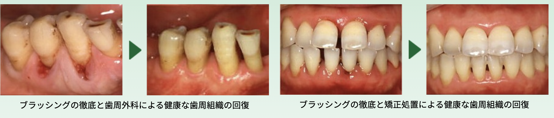 歯周病の方もご相談ください。