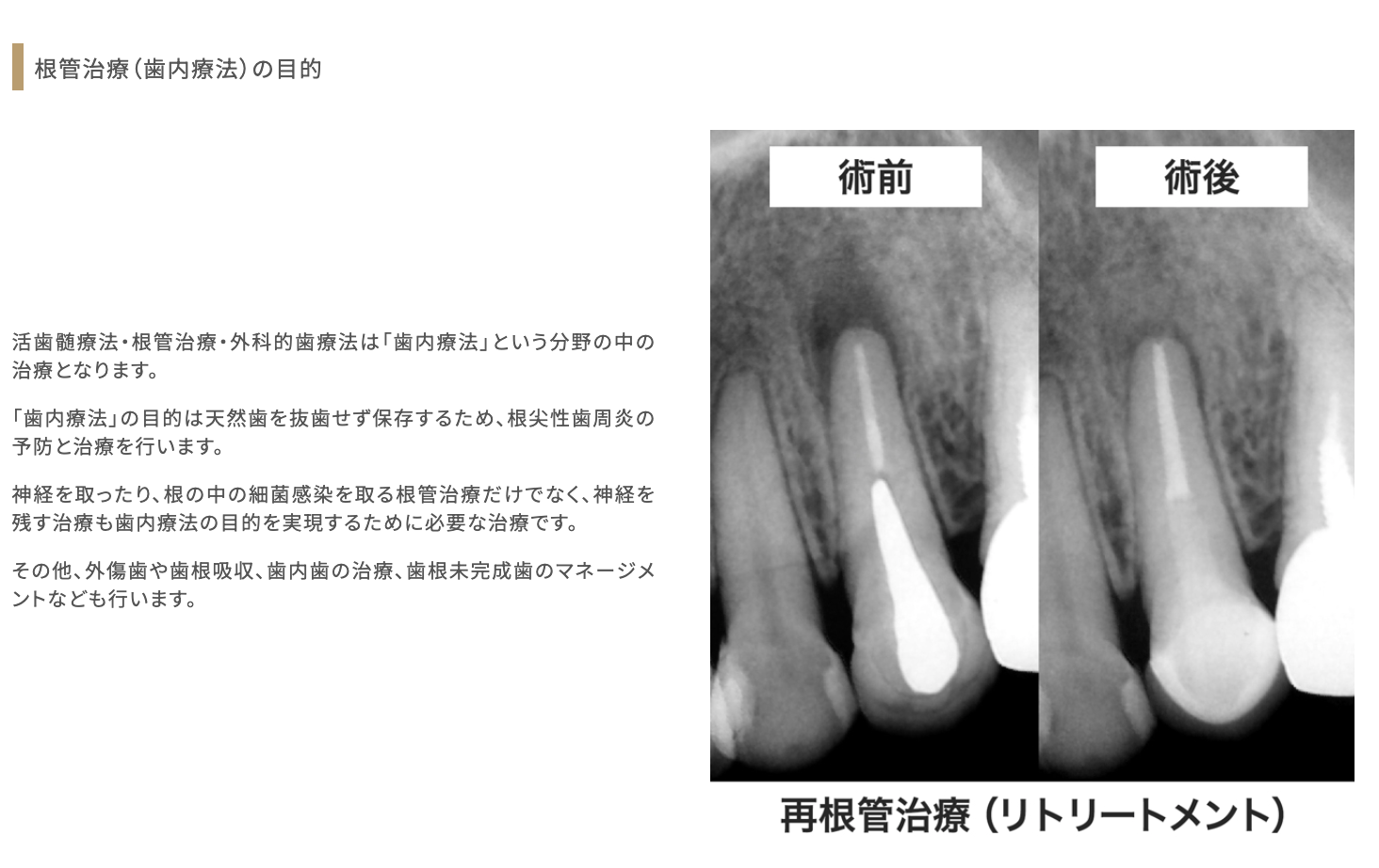 歯を可能な限り保存することを目的とした精密な根管治療を行っています