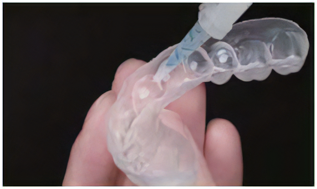 ホームホワイトニング