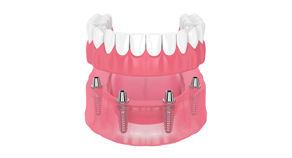 入れ歯のお悩みにはオールオン4という治療をご提案します