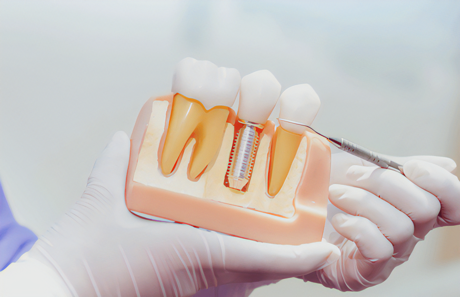 多様なインプラント治療を提供