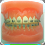 メタルブラケット