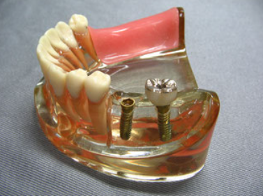 インプラント治療で、天然歯に近い見た目と噛み心地を手に入れましょう