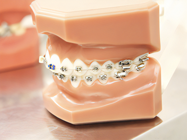 固定式の矯正装置