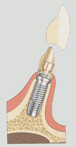 骨の健康を維持しながら義歯をしっかり支えるため、より快適で安心な生活を提供します